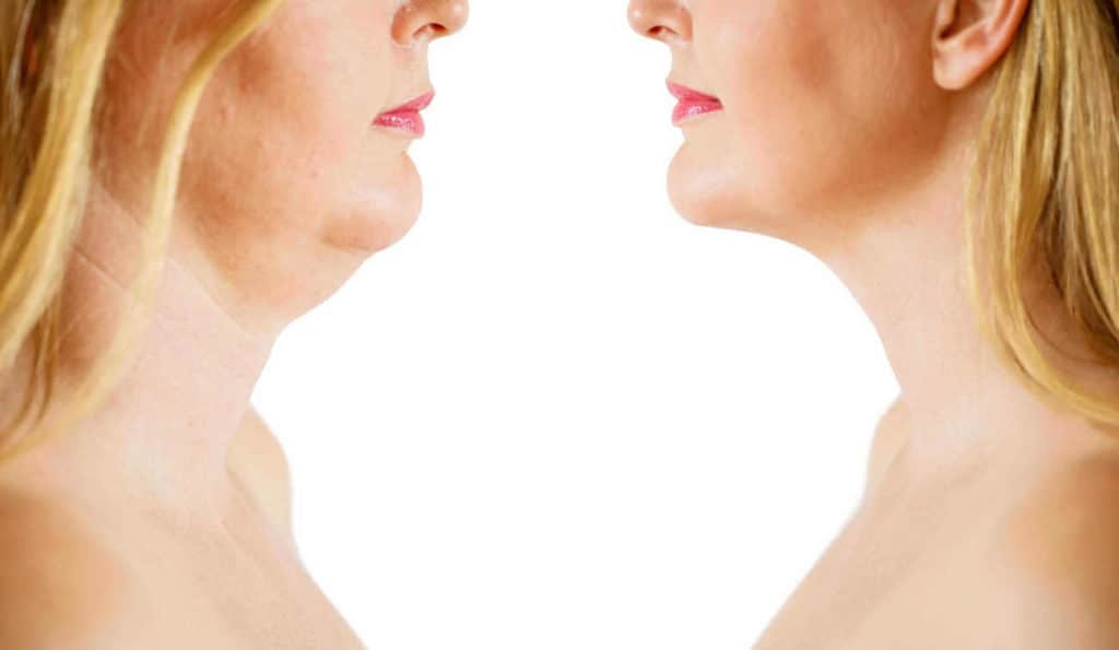 Double Chin treatment Oxford before and after results