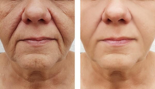 Learn more about Morpheus8 Treatment Oxford today!