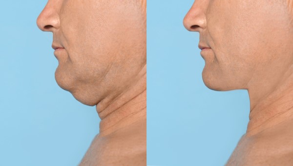 Which Non-Surgical Treatments Work Best for Jowls and Loose Skin Oxford?