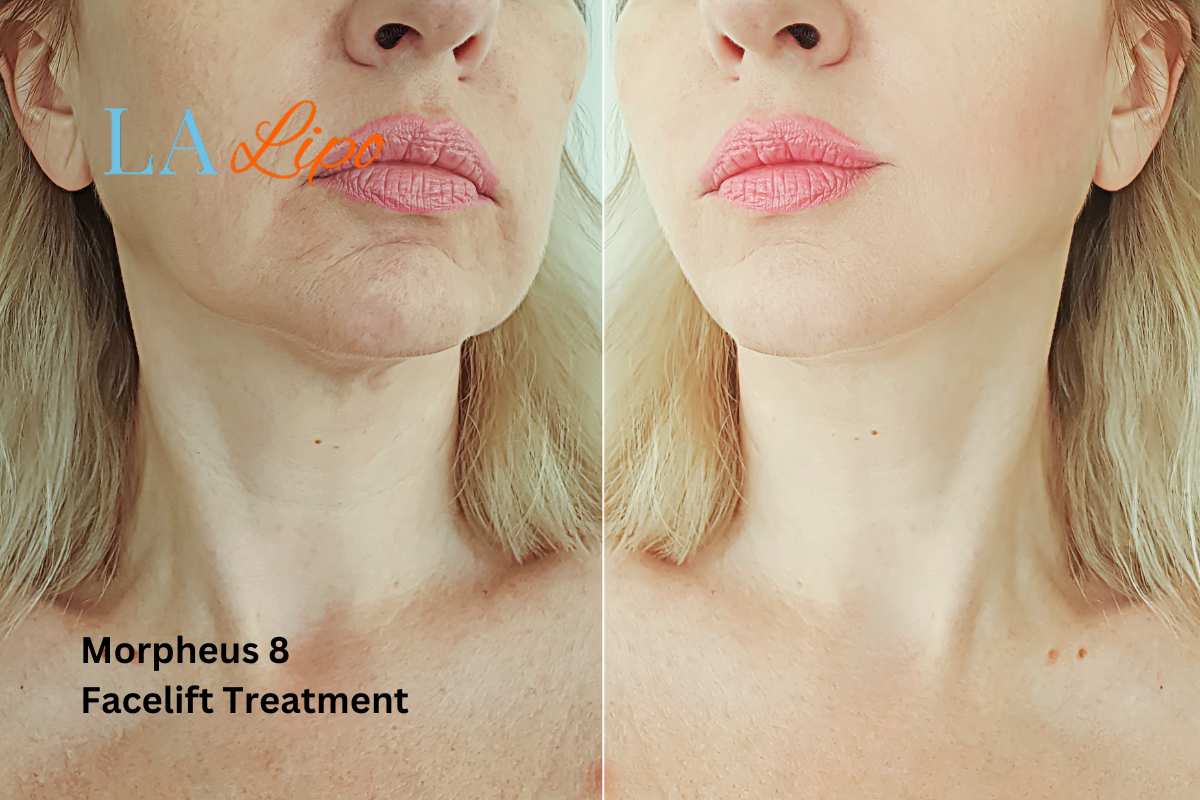 Turn back time with Morpheus8 Treatment Oxford