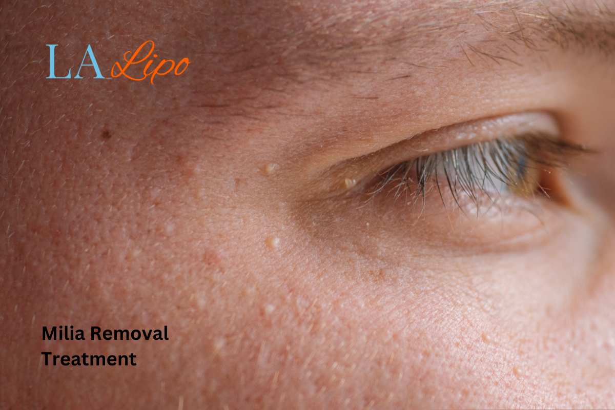 Cryopen Milia Removal: Is It the Easiest and Safest Option Oxford?