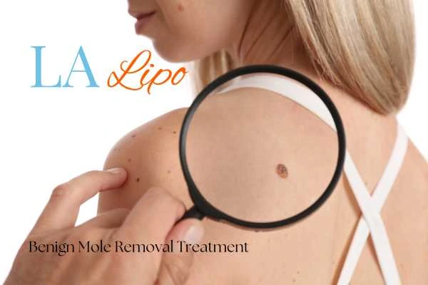Woman having her inspection of blemish before mole removal Oxford