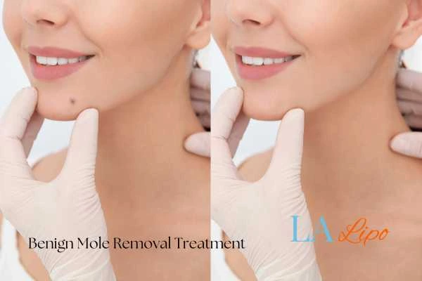 Before and after mole removal Oxford treatment