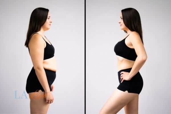 image of woman before and after results of LA-EMS Body Sculpting Oxford to help treat Diastasis recti
