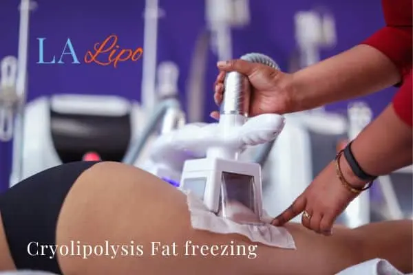 women getting fat freezing Oxford