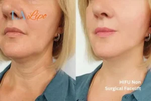 hi-fu for wrinkles Oxford before and after results