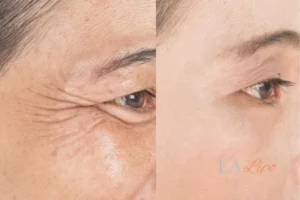 Before and after results of woman - HI-fu wrinkles reduction treatment Oxford