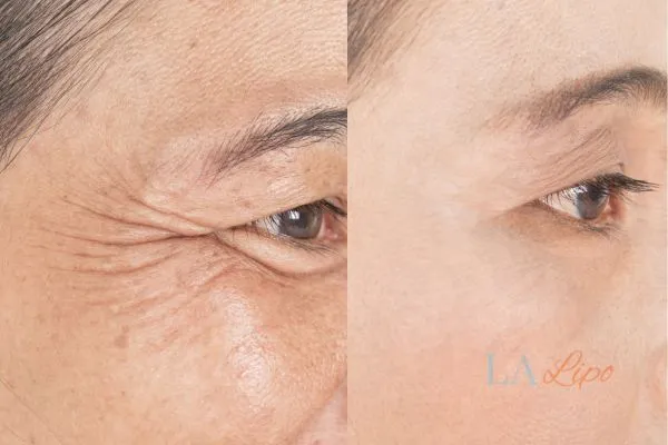 Before and after results of woman - HI-fu wrinkles reduction treatment Oxford
