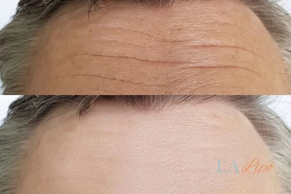 results of HIFU Oxford on mans forehead to help reduce lines and wrinkles