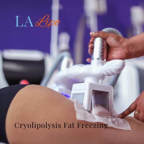 fat freezing - Cryolipolysis Oxford