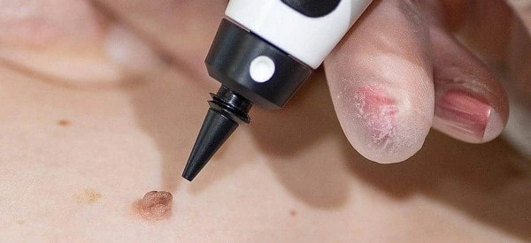 skin tag removal using cryopen Oxford