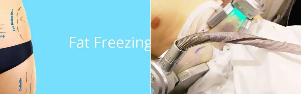 Fat freezing Oxford on multiple areas of the body