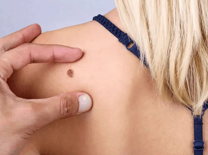 woman having mole removal Oxford consultation before treatment.