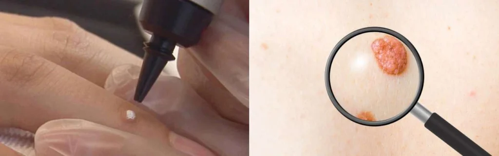 Person getting moles removed with cryopen Oxford