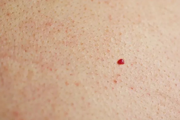 close up of a cherry angioma Oxford