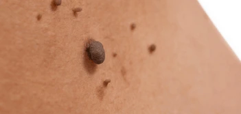 image of a skin tag Oxford