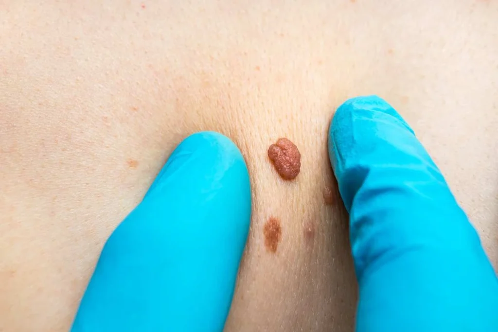 Consultant examining a skin tag Oxford