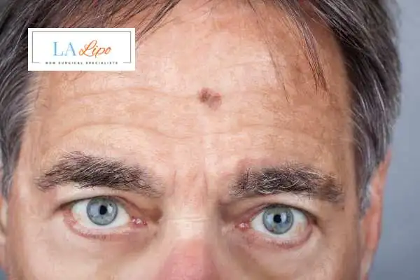 Solar Lentigo Removal Oxford image of man with mark on his forehead
