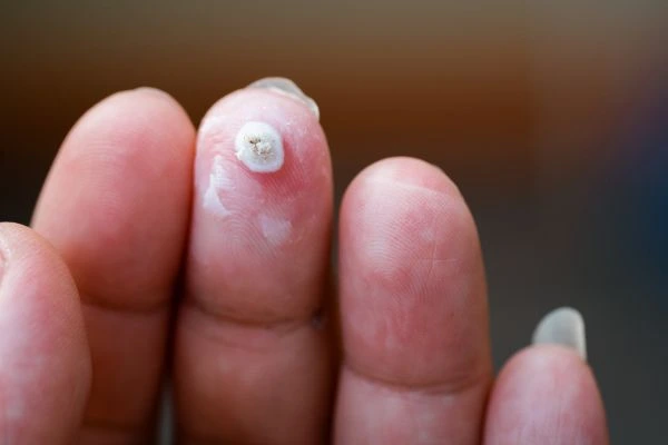 wart on person finger - cryotherapy to treat from LA LIPO Oxford