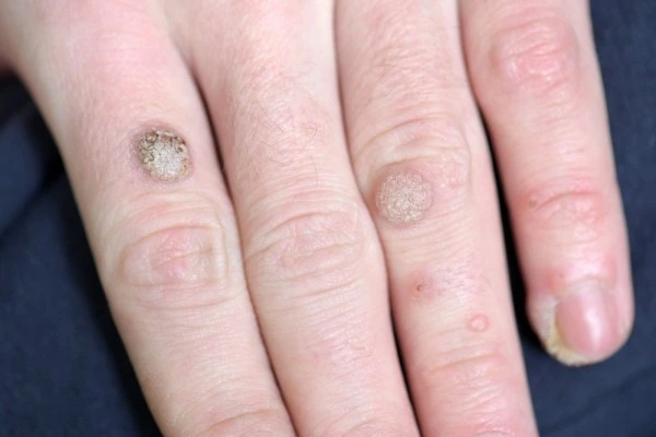 photo of warts on person hand - see wart removal Oxford from LA LIPO