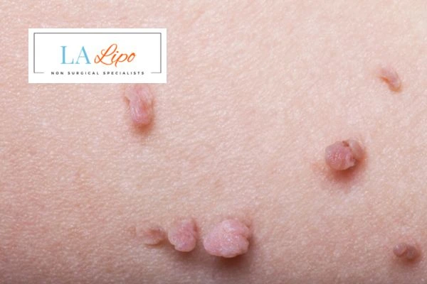 Does cryopen skin tag removal Oxford hurt? Find out now call our team today!