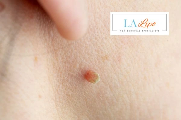 Book skin tag removal Oxford today speak to our team now!