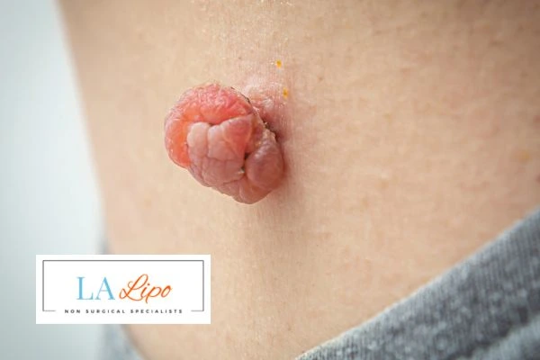 Interested in skin tag removal Oxford? Concerned about the pain? Find out more today!