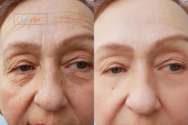 The powerful benefits of Morpheus8 Treatment Oxford - Call Our team today!