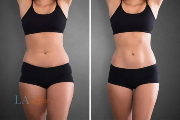 before and after results of non-surgical treatment to help a woman's body image and mental health Oxford