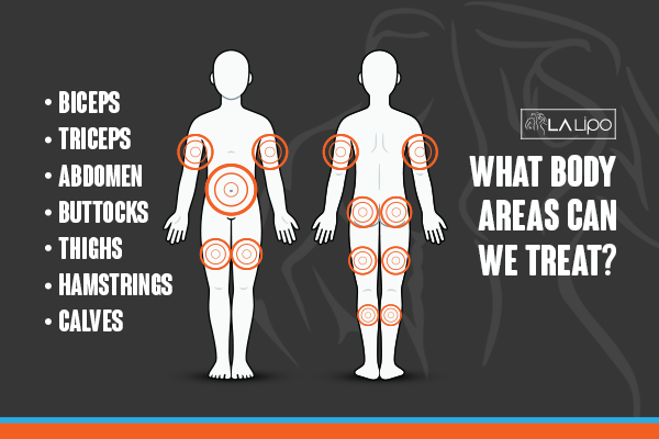 Diagram to show areas you can have LA-EMS Body Sculpting Treatment Oxford