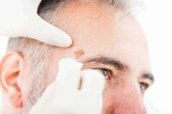 Age spots and elderly people Oxford what is the link?