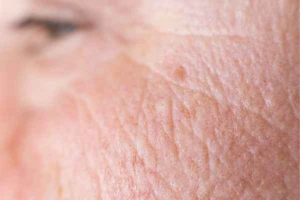 close up picture of a woman's face showing an age spot Oxford