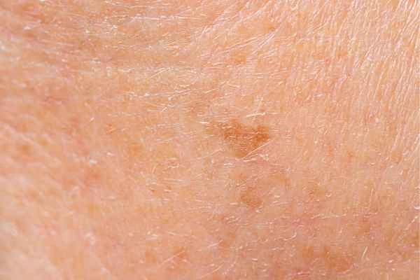close up picture of age spots Oxford