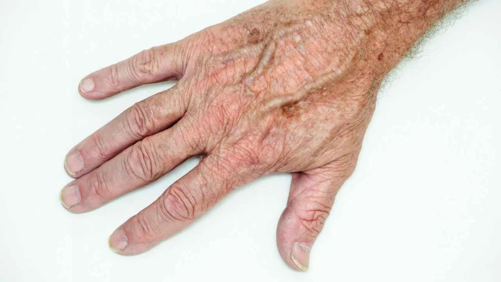 Male hand showing age spot Oxford