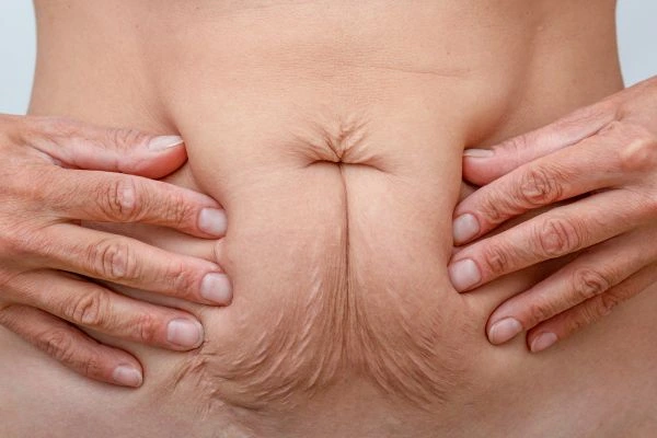 Image of a woman's stomach with loose skin - example of skin tightening Oxford options