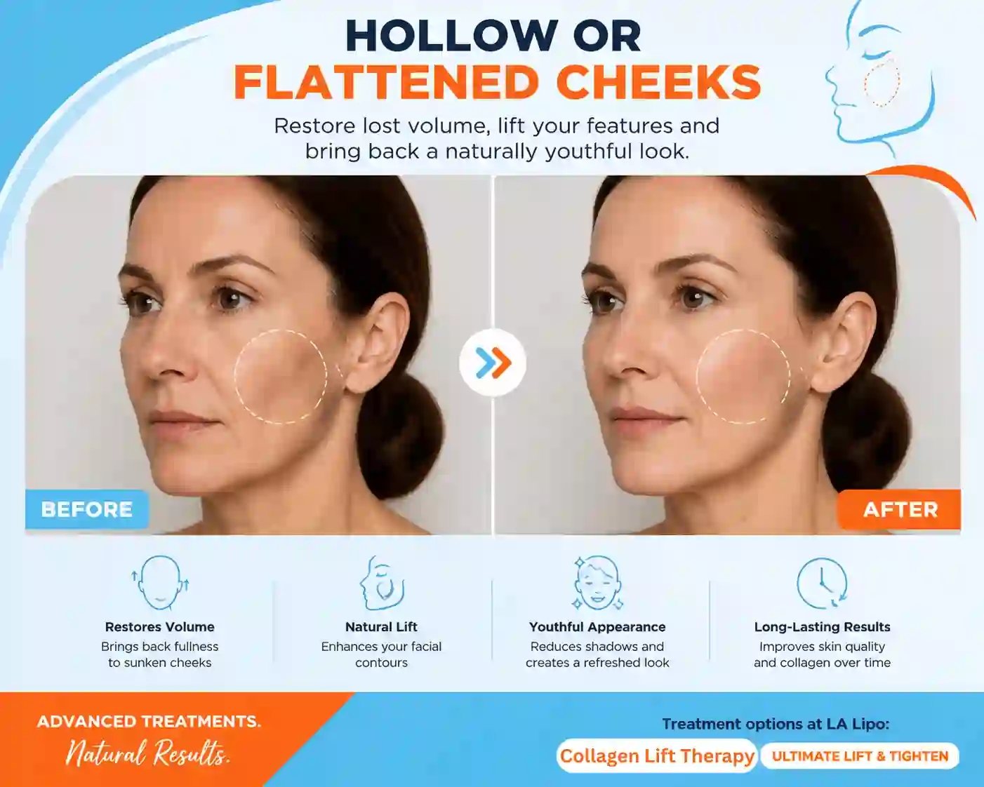 Sign #4: Hollow or Flattened Cheeks Oxford