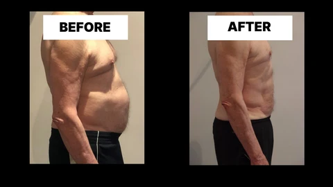 What Symptoms Can Diastasis Recti Cause in Men? Weak Core, Back Pain and Poor Posture Oxford